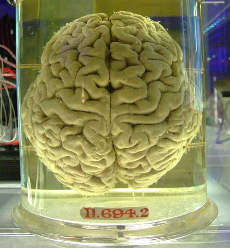 Michael Jackson's brain