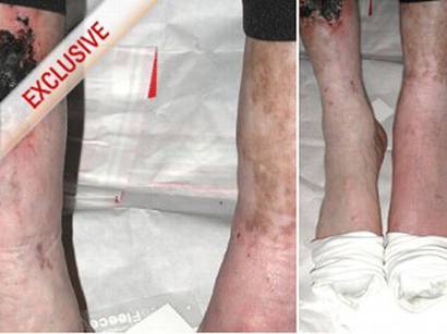 Michael Jackson-foot-wounds